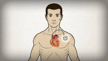 Automated Implanted Cardioverter Defibrilator