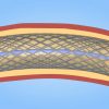 What is a Stent? (MUMH)